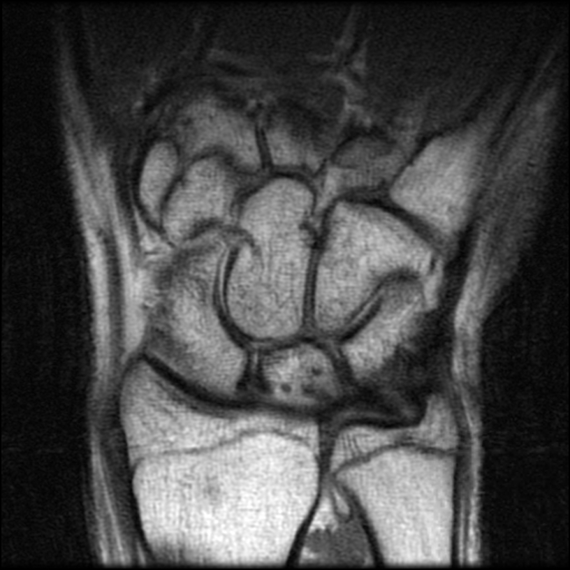 Figure 3 for case ulna stress fracture